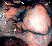 分化型胃がんの例