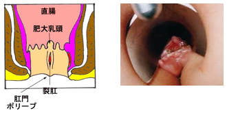 裂肛（切れ痔）