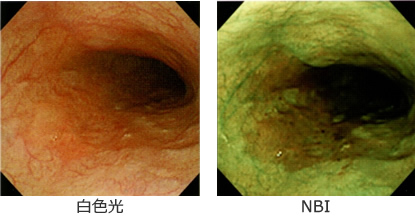 早期食道癌（粘膜内癌）