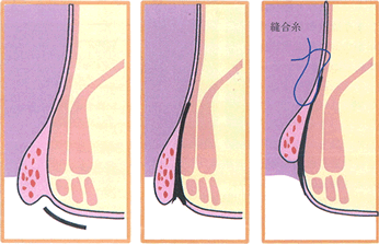 肛門形成術