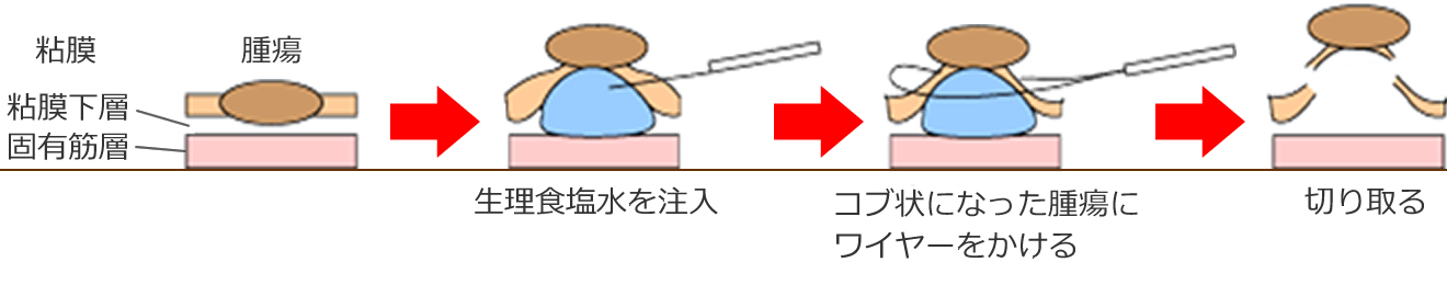 大腸ポリープの内視鏡的治療、内視鏡的粘膜切除術（EMR）