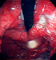 未分化型胃がんの例