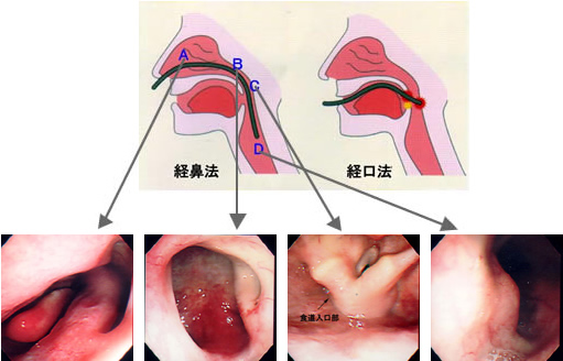 経鼻内視鏡検査