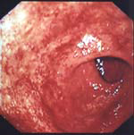 潰瘍性大腸炎症候群