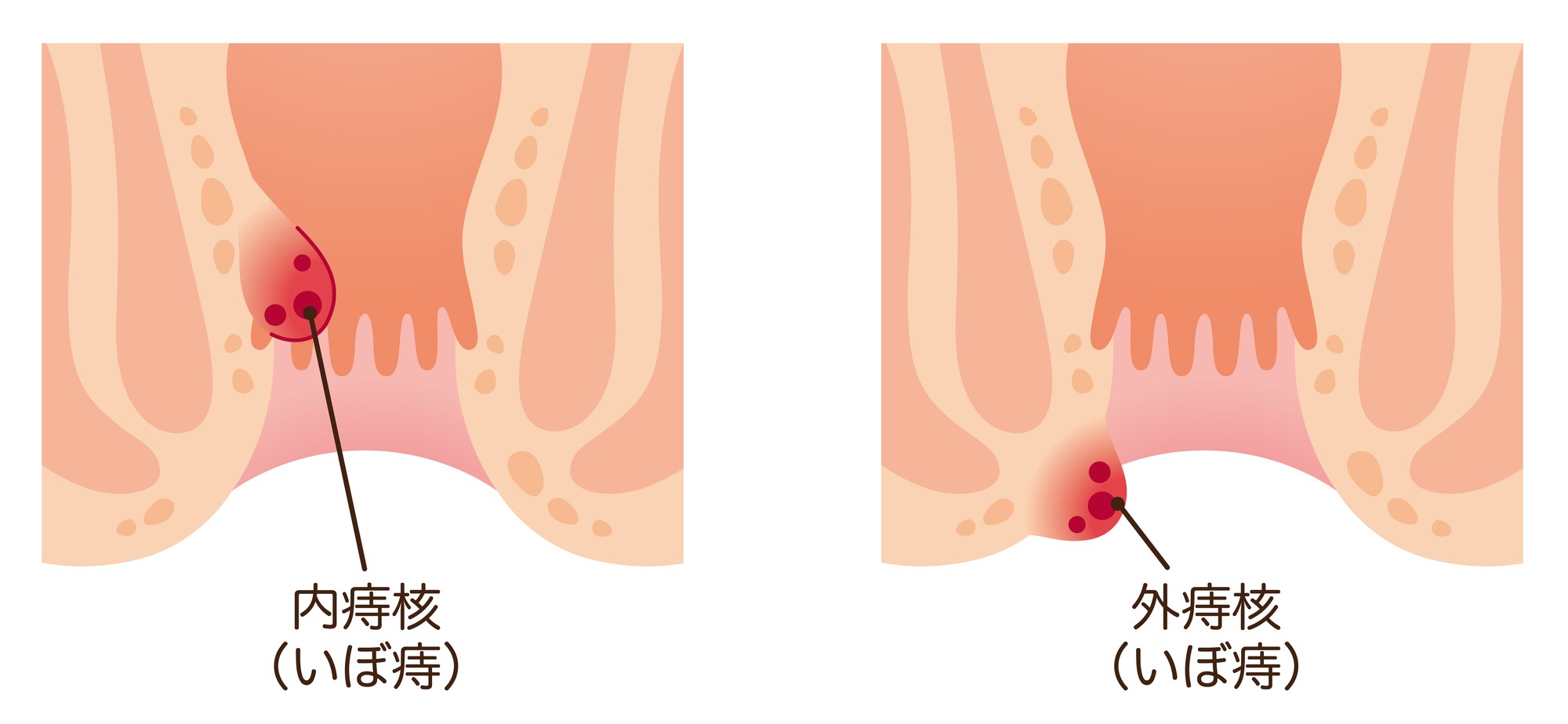 痔核(いぼ痔)