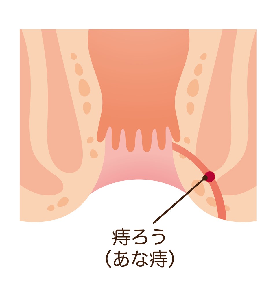 痔ろう