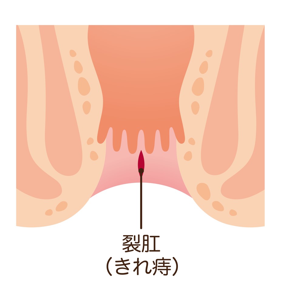 裂肛(切れ痔)