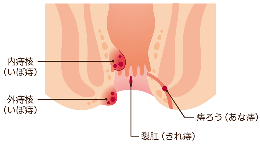 いぼ痔 痔の種類