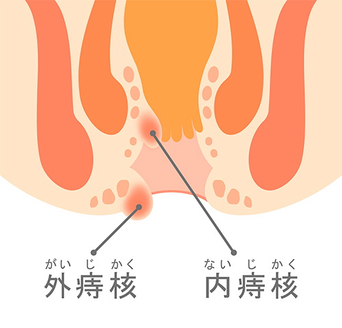 内痔核 外痔核 2種類のいぼ痔