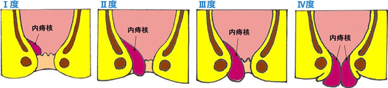 脱肛の程度 4段階
