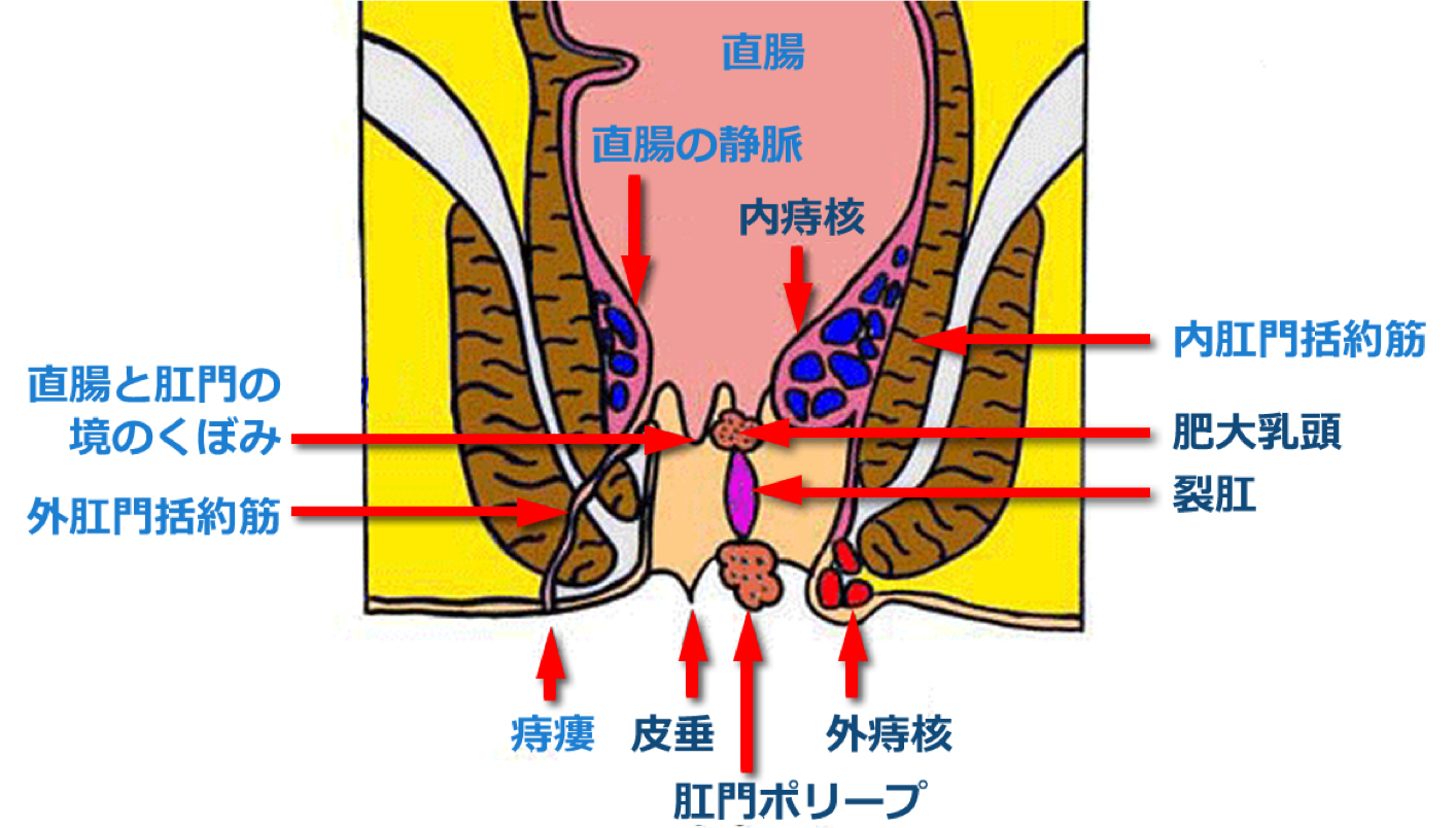 肛門がんと痔核の潜在的な合併症