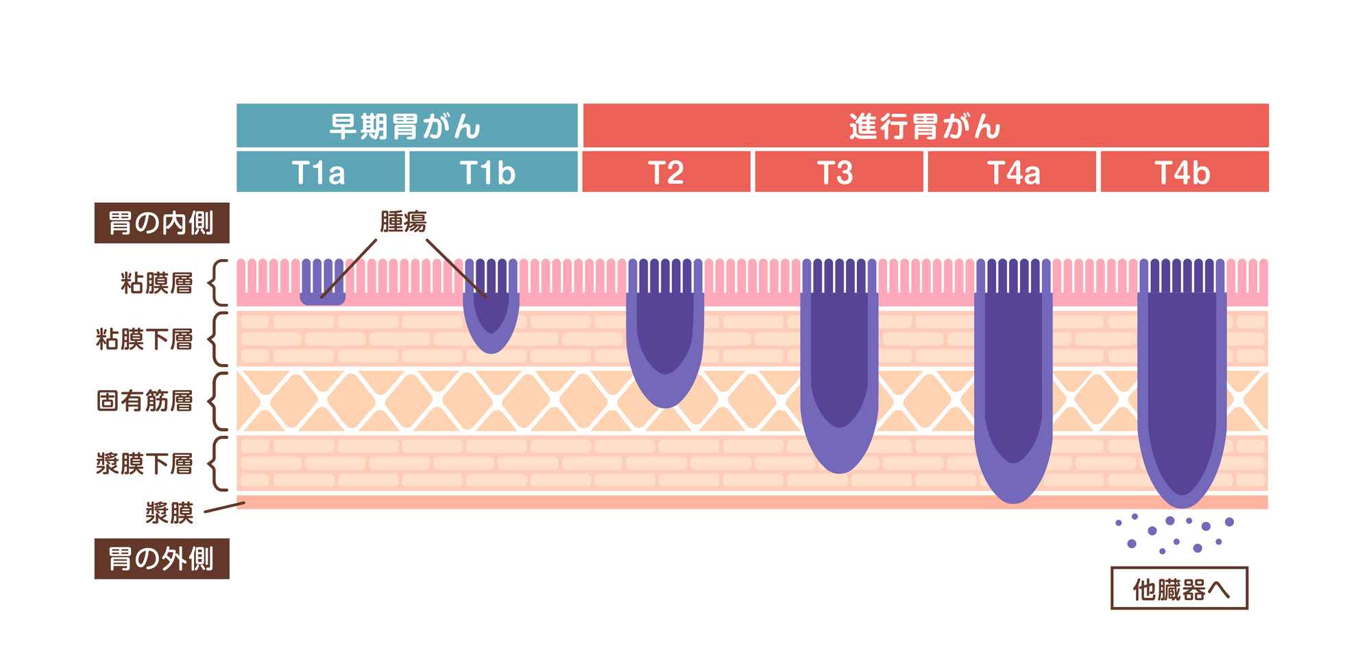 胃がんの病期（ステージ）